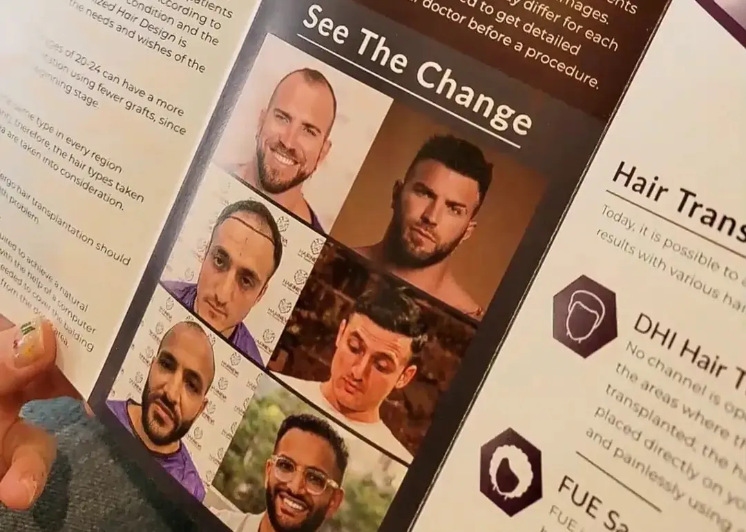 Brochure showing before and after photos of men who had hair transplant procedures in Istanbul, highlighting visible results.