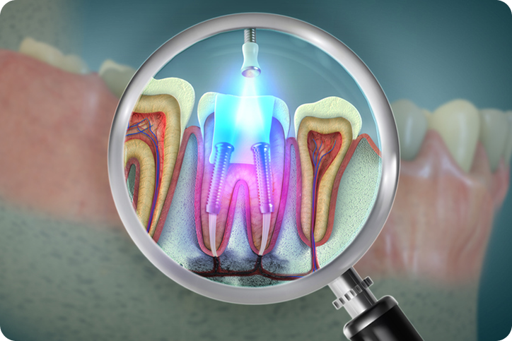 Dental illustration showing root canal implants under a magnifying glass.