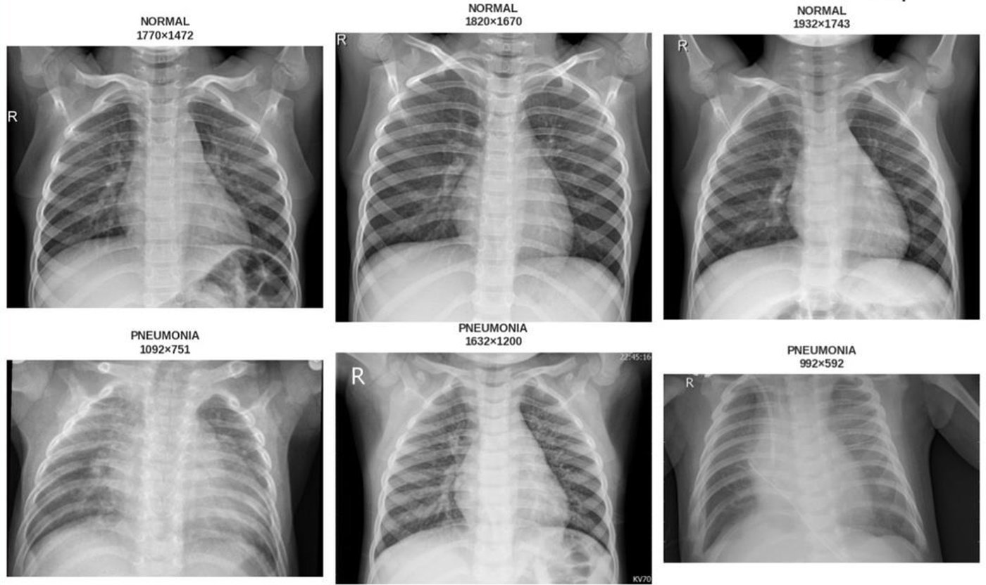 Chest X-rays: three normal cases on top, three pneumonia cases below