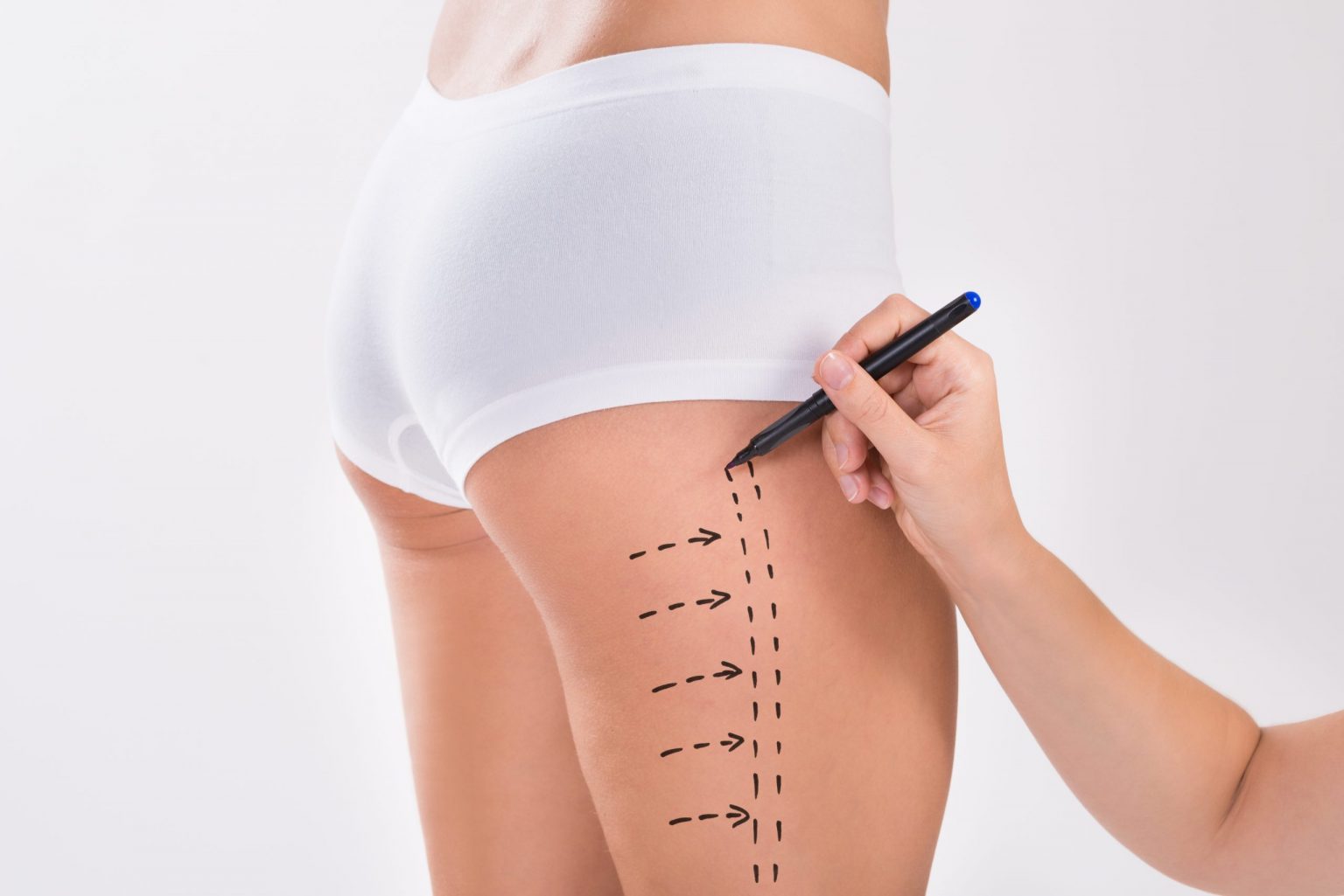 Lifting des cuisses (cruroplastie)