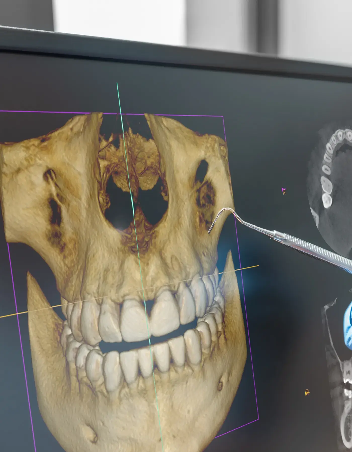 Computer screen showing a 3D dental scan of a jaw with teeth and a dental probe pointing at the image.
