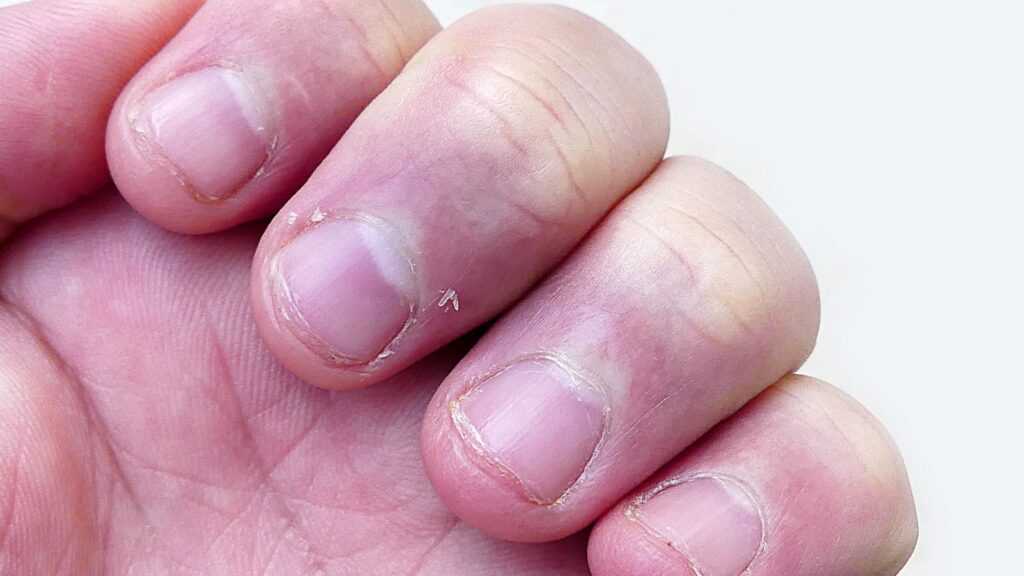 Iron Deficiency Brittle Nails Sacramento Roseville