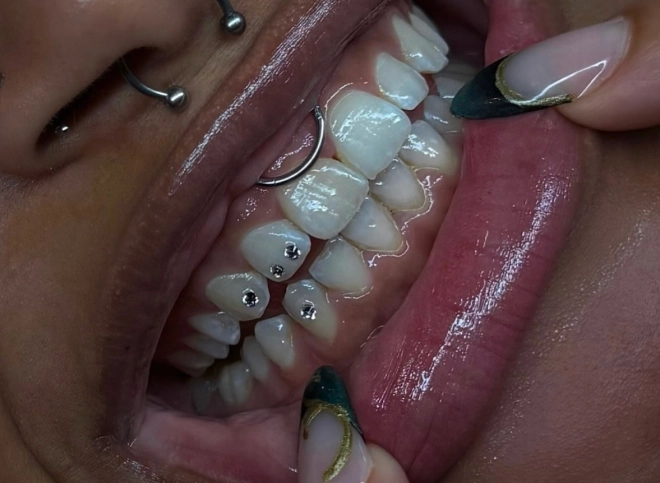 Nahaufnahme eines verzierten Lächelns mit silbernen Tooth Gems