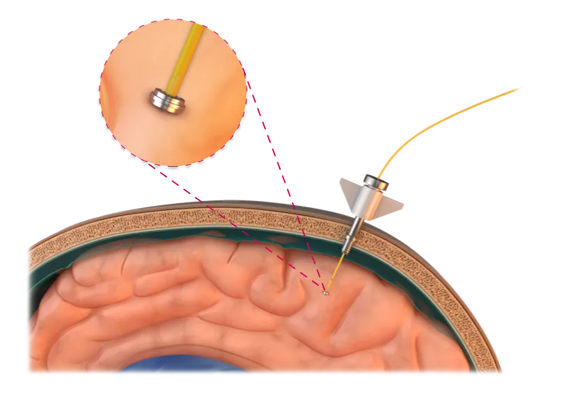 Graphic rendering of a human brain and skull with a tisense implantable.