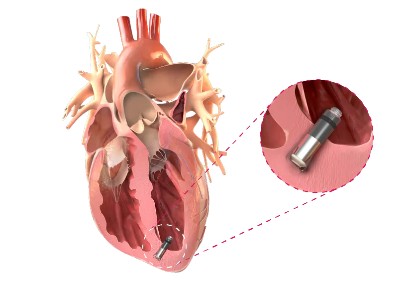 Graphic rendering of a human heart with a Tisense implantable.