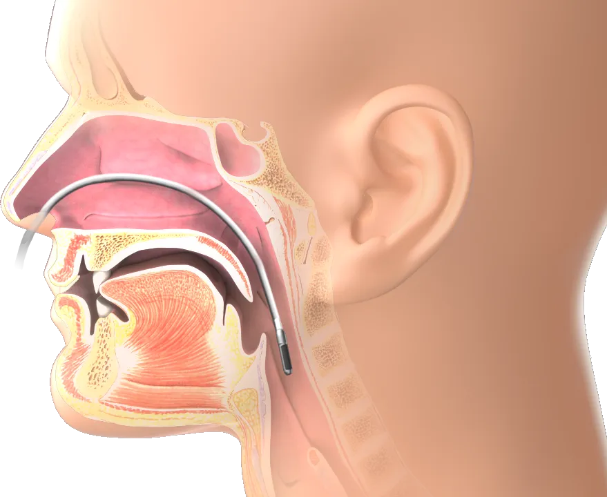 A graphic rendering of a human respiratory tract with Millar’s Mikro-Cath.