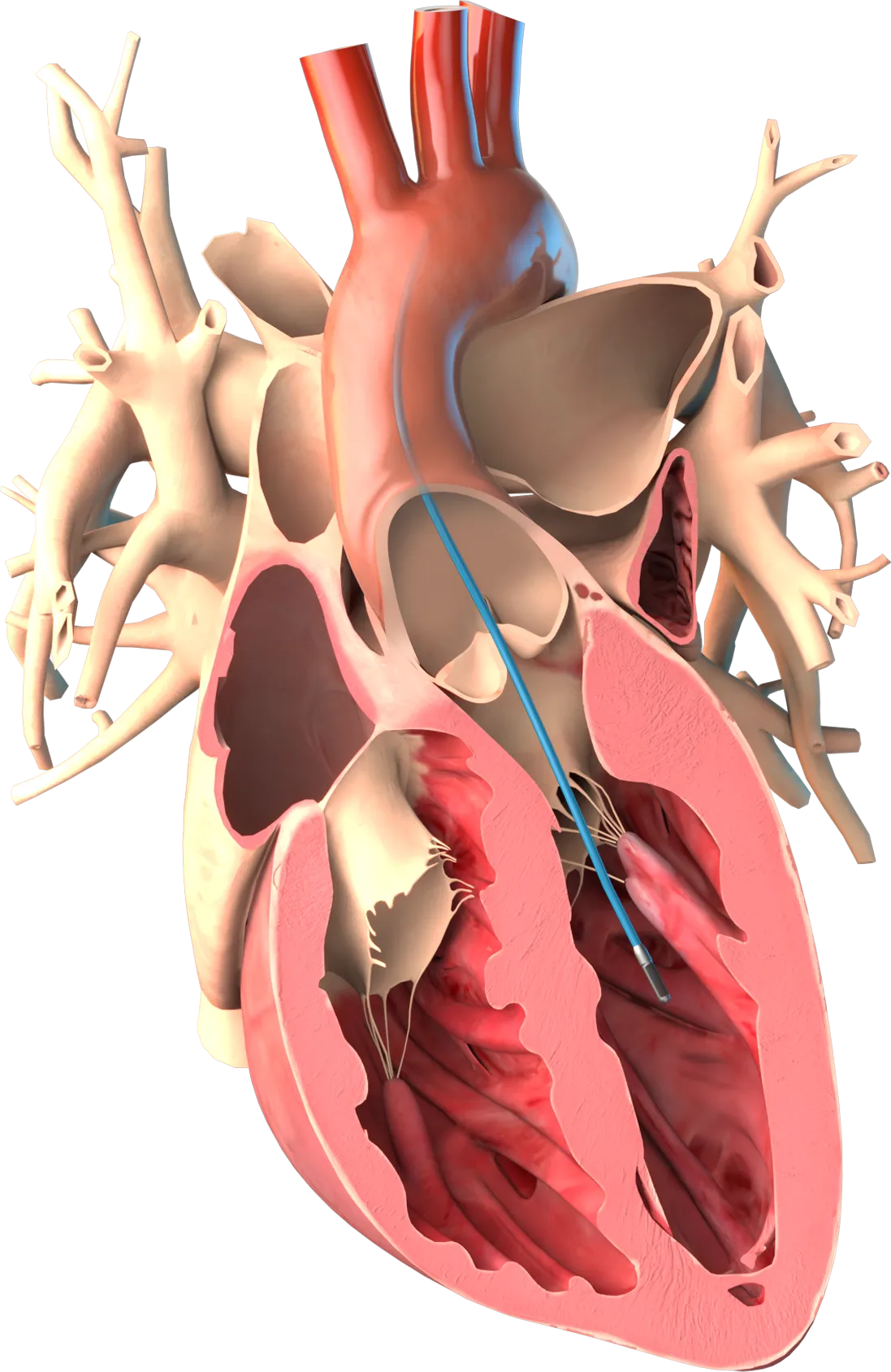 A graphic rendering of a human heart with Millar’s Mikro-Cath pressure catheter.