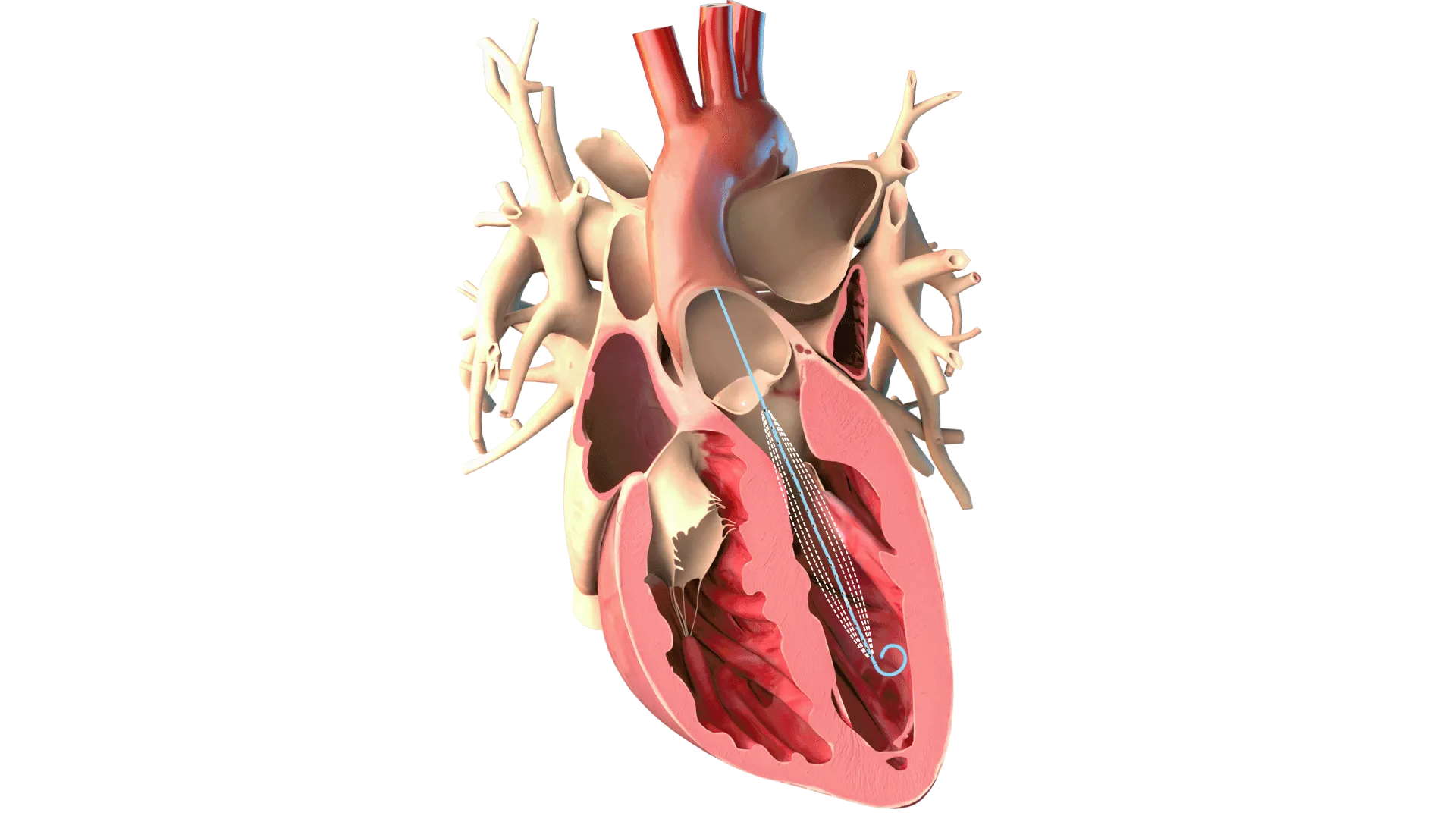A graphic rendering of a human heart with an Admittance Pulmonary Artery Catheter.
