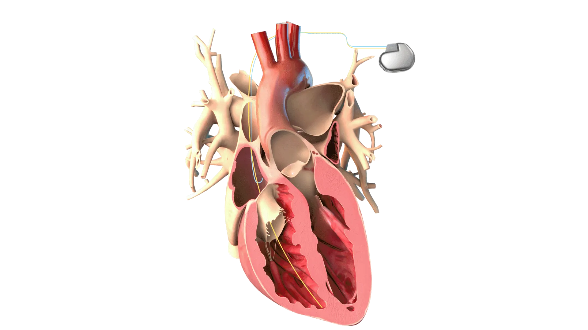 A graphic rendering of a human heart with an Admittance Implantable Cardioverter-Defibrillator.