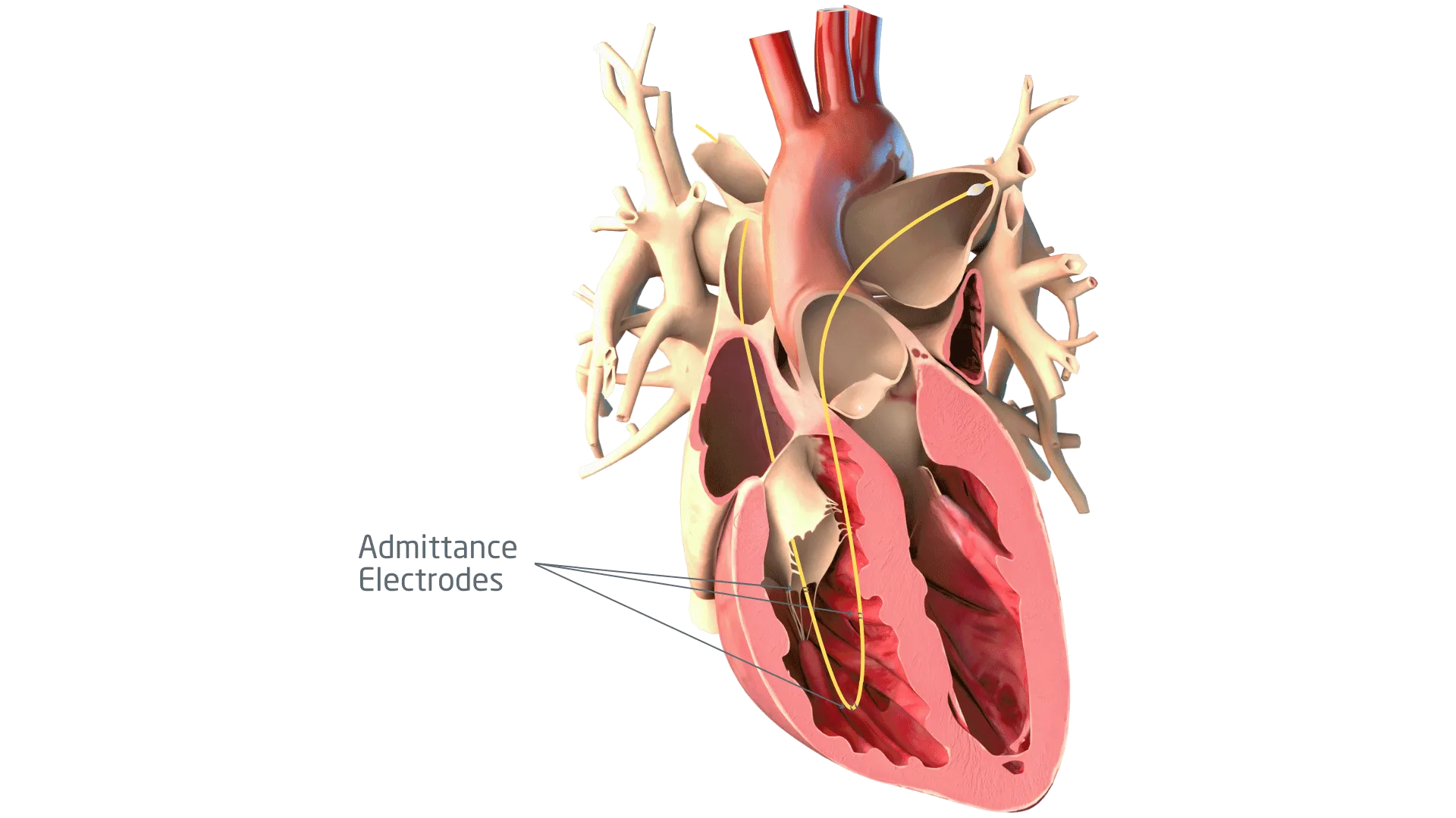 A graphic rendering of a human heart with a Pressure Volume (PV) catheter.