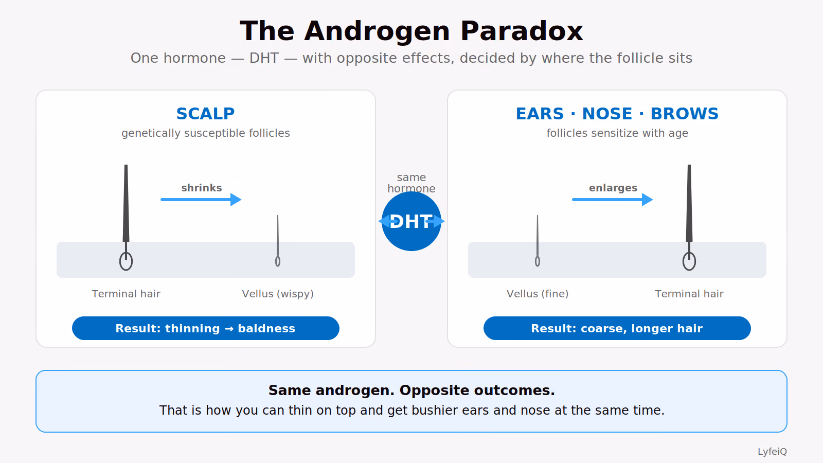 Two-panel diagram of the androgen paradox: on the scalp, DHT shrinks terminal follicles into wispy vellus hair and drives thinning, while in the ears, nose, and brows the same DHT enlarges vellus follicles into coarse terminal hair — one hormone, opposite results set by the follicle’s location.
