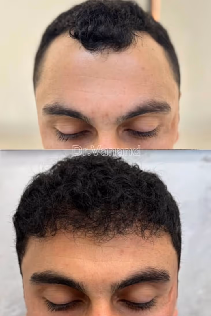 Estetime Hair Transplant clinic - before and after result of our patient.