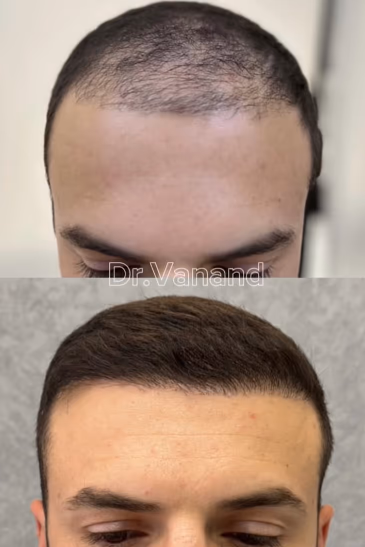 Estetime Hair Transplant clinic - before and after result of our patient.