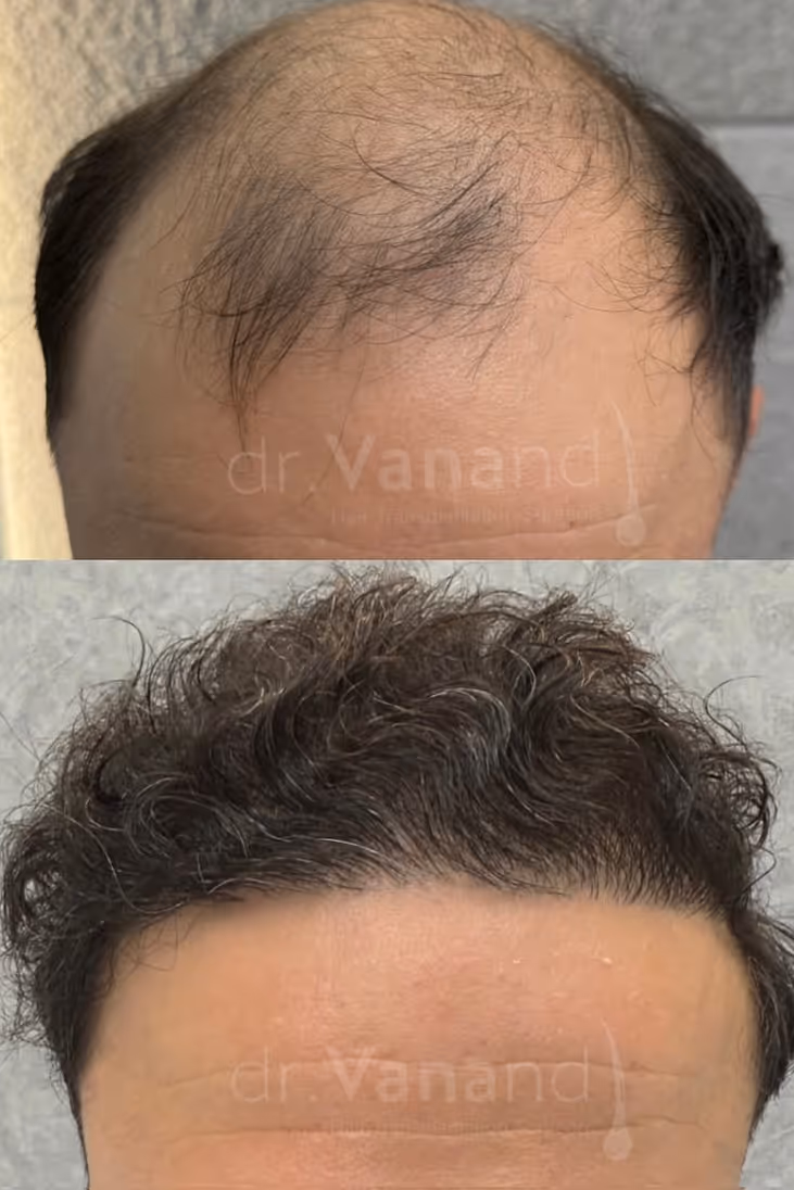 Estetime Hair Transplant clinic - before and after result of our patient.