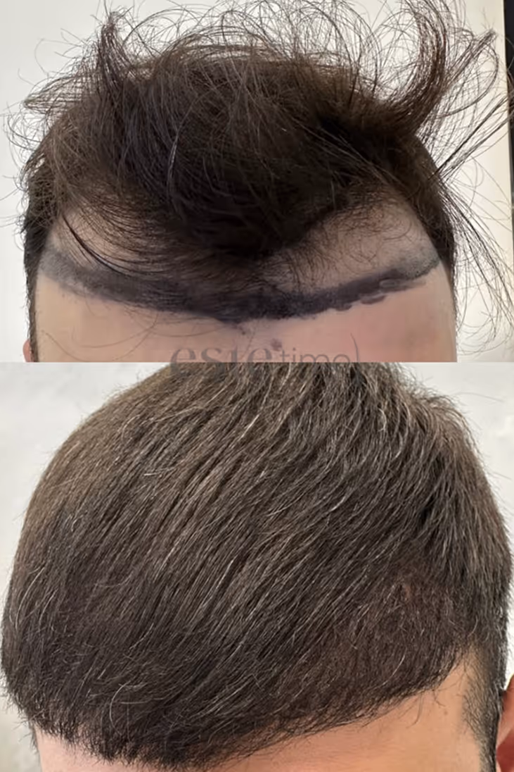 Estetime Hair Transplant clinic - before and after result of our patient.