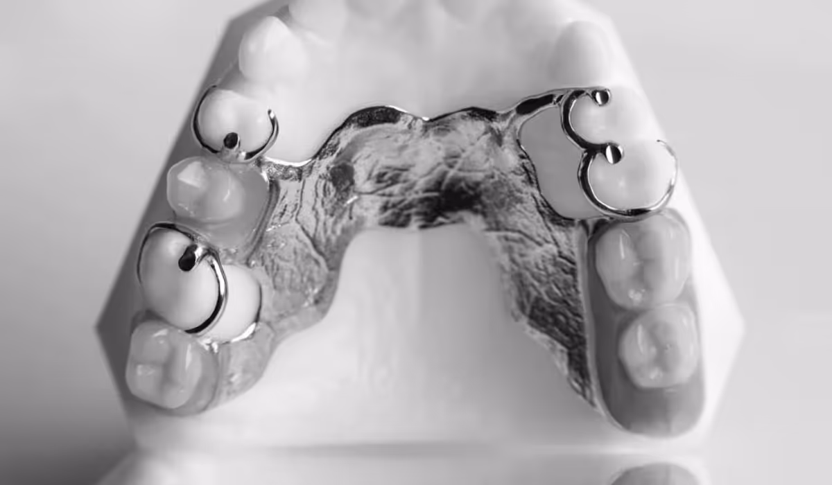 Dental model showing a removable partial denture with metal clasps attached to natural teeth.