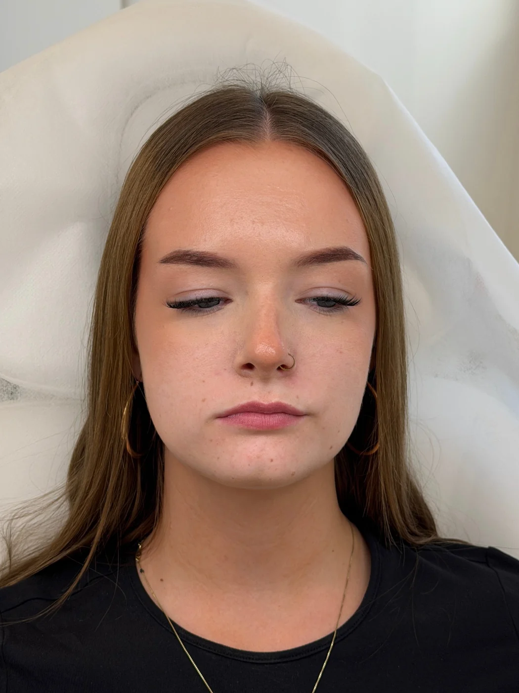 Před ošetřením u MUDr. Anastasiyi Shpak – ukázka 2, Lumea Clinic