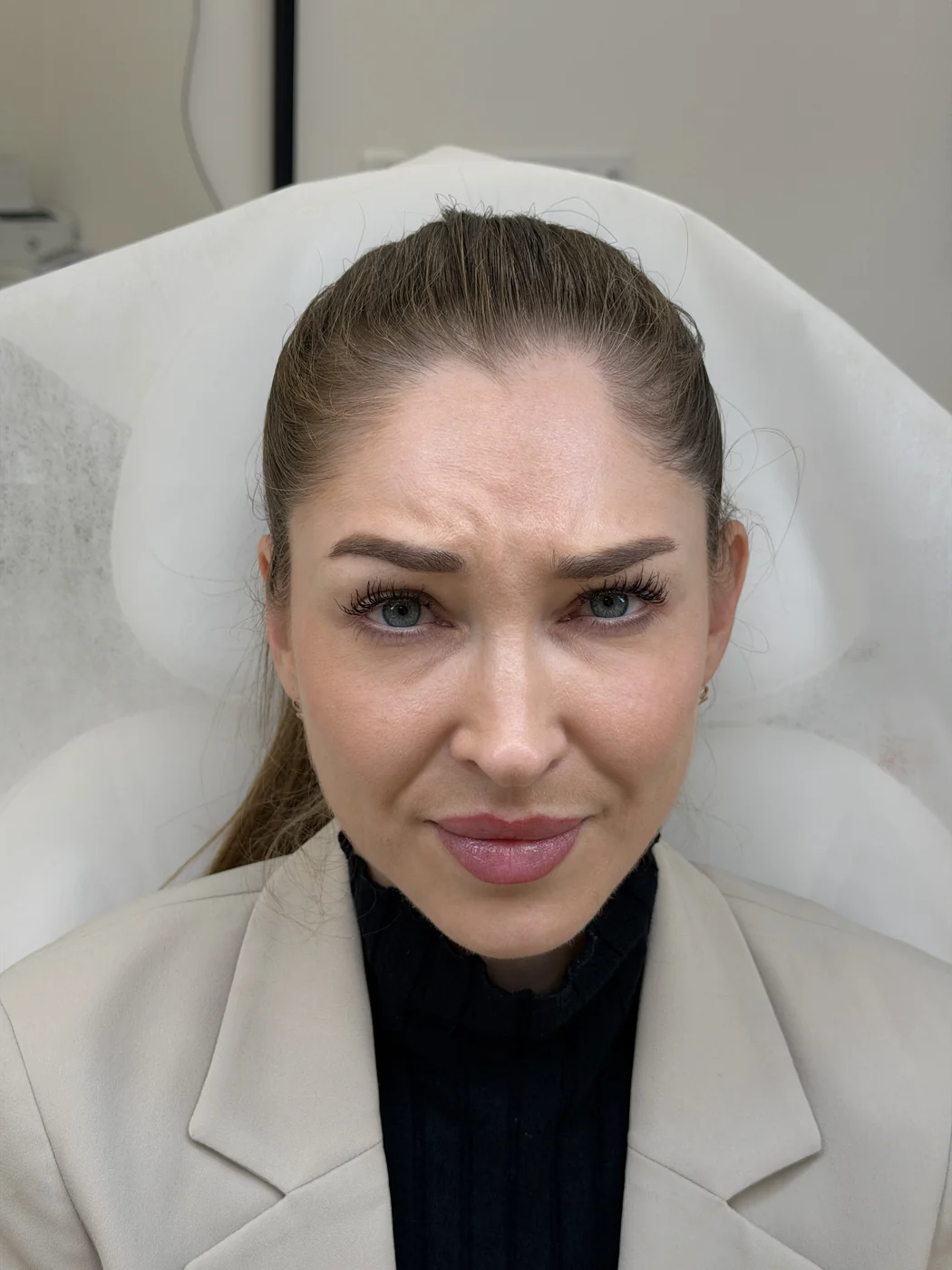Před ošetřením u MUDr. Anastasiyi Shpak – ukázka 3, Lumea Clinic