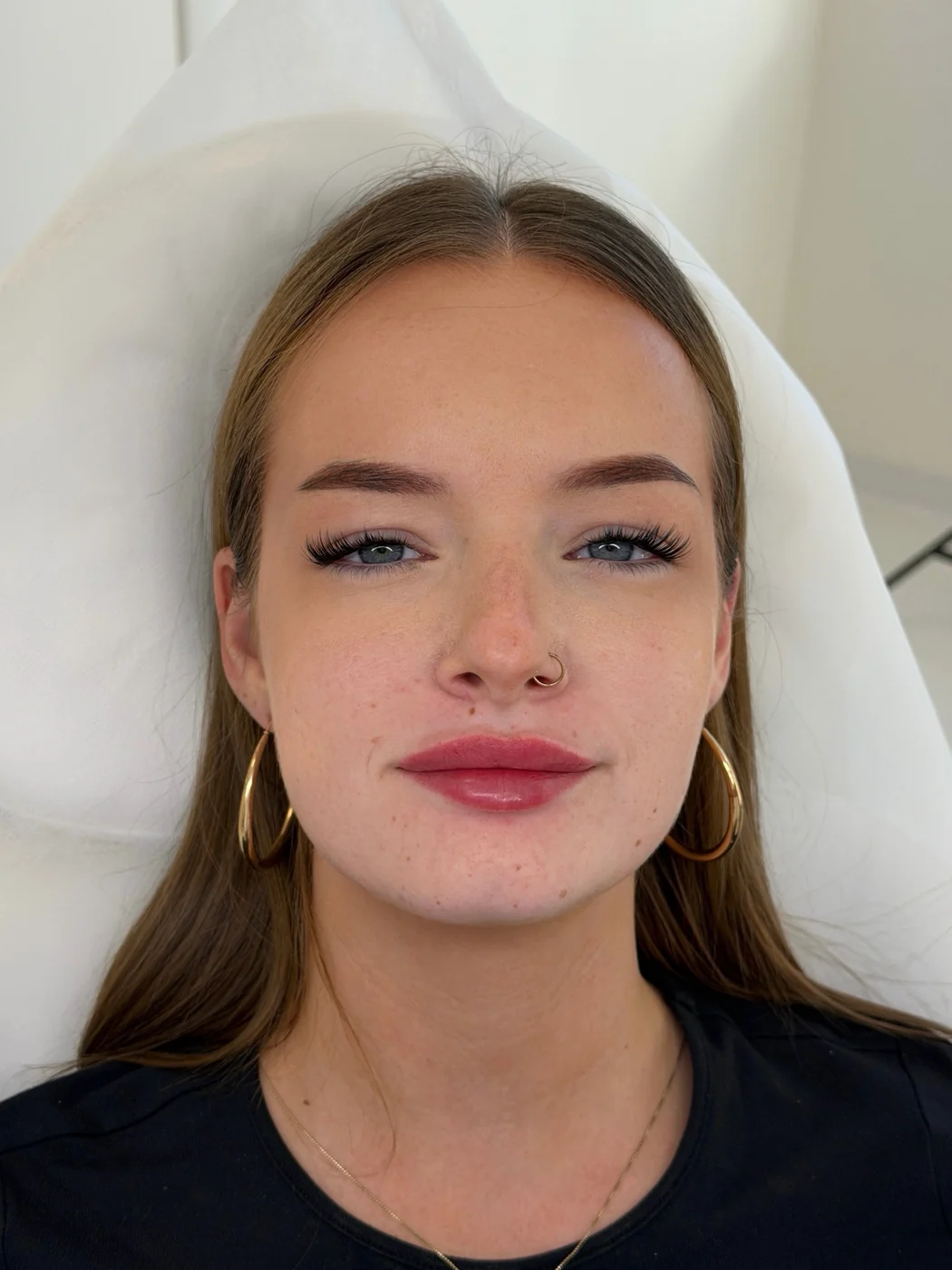 Po ošetření u MUDr. Anastasiyi Shpak – ukázka 2, Lumea Clinic