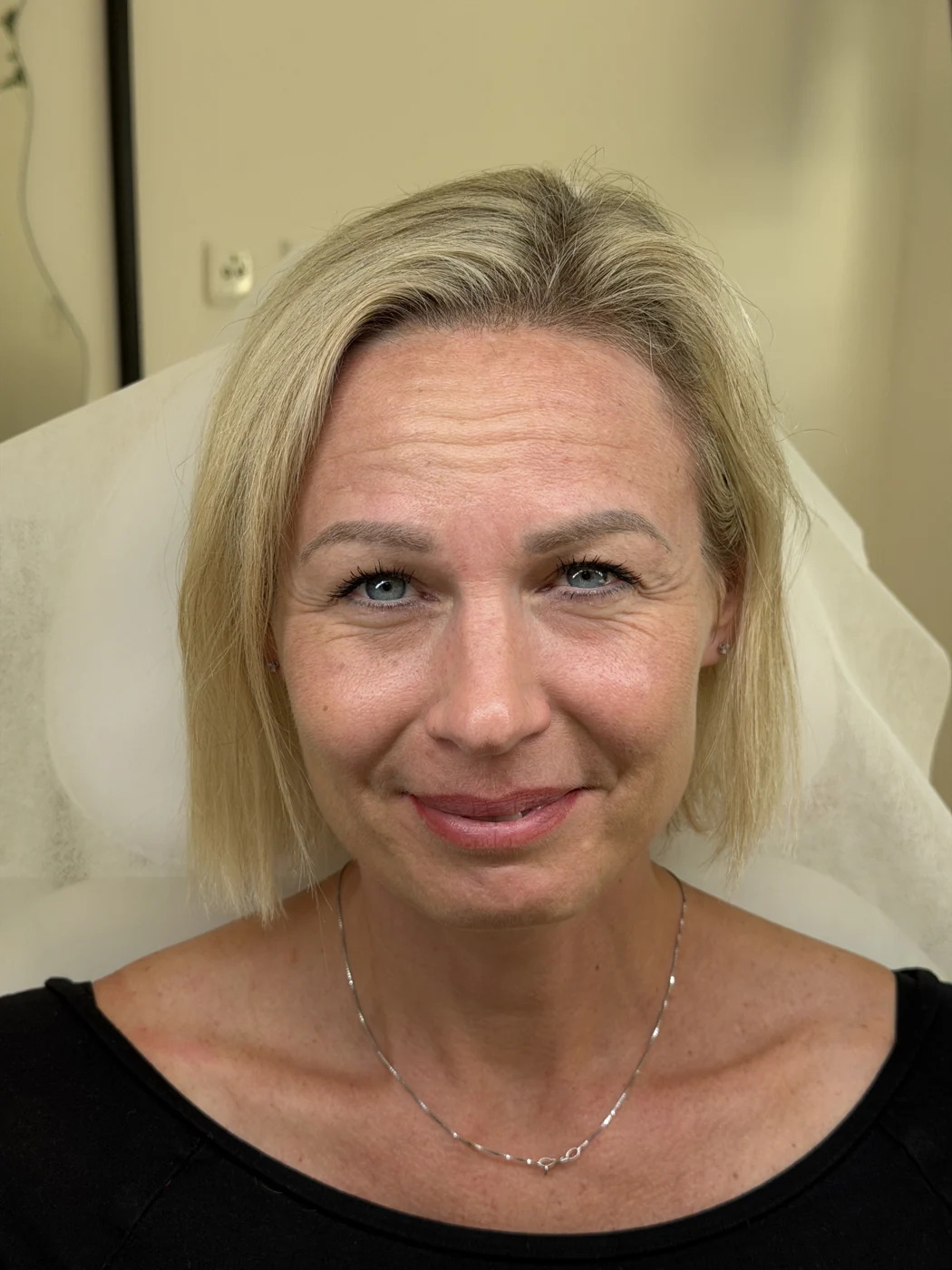 Před ošetřením u MUDr. Anastasiyi Shpak – ukázka 4, Lumea Clinic