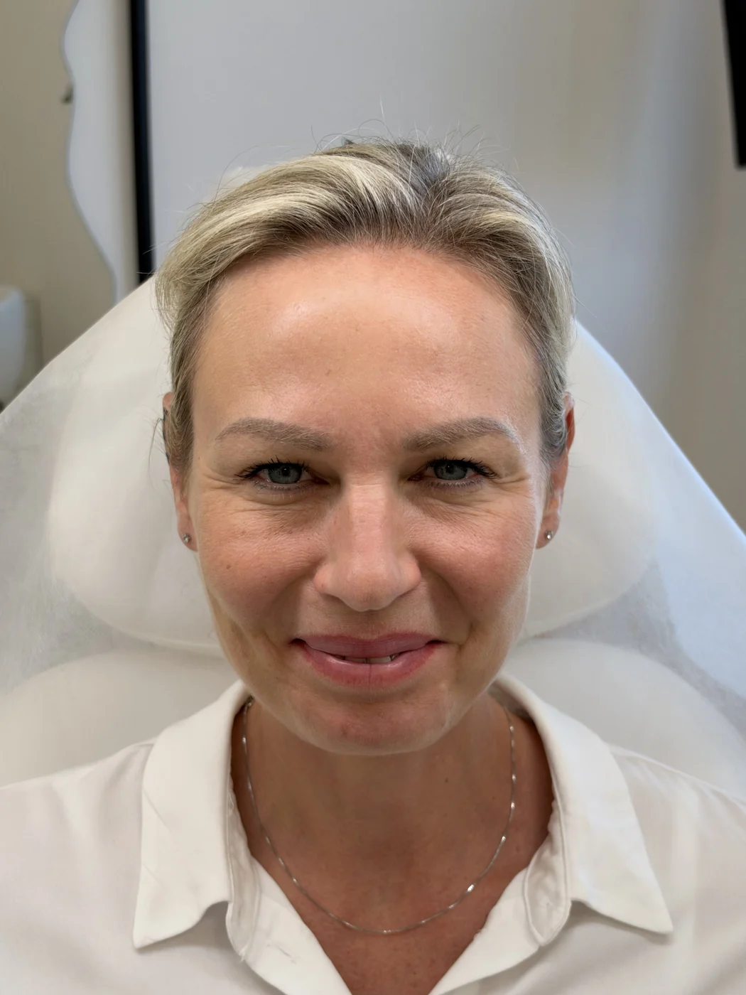 Po ošetření u MUDr. Anastasiyi Shpak – ukázka 4, Lumea Clinic
