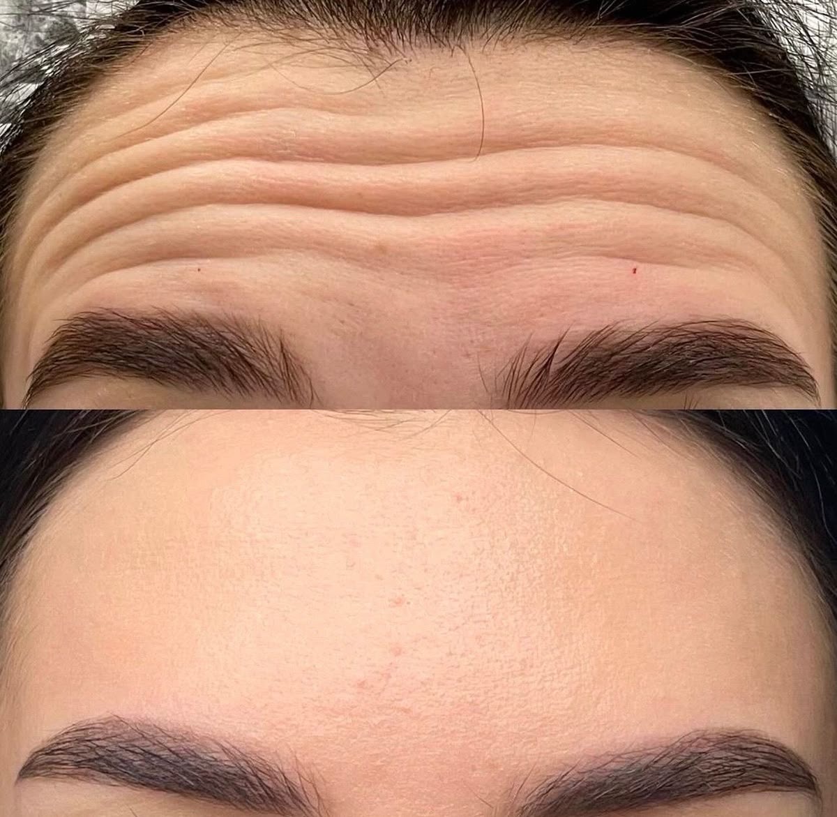 Forehead before and after expression line treatment with a neuromodulator
