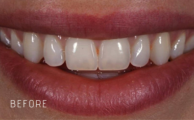 Close-up of a smile showing teeth before dental treatment with a visible gap between front teeth.