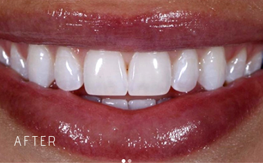 Close-up of a smile showing clean, white teeth and glossy lips with the word AFTER in the corner.