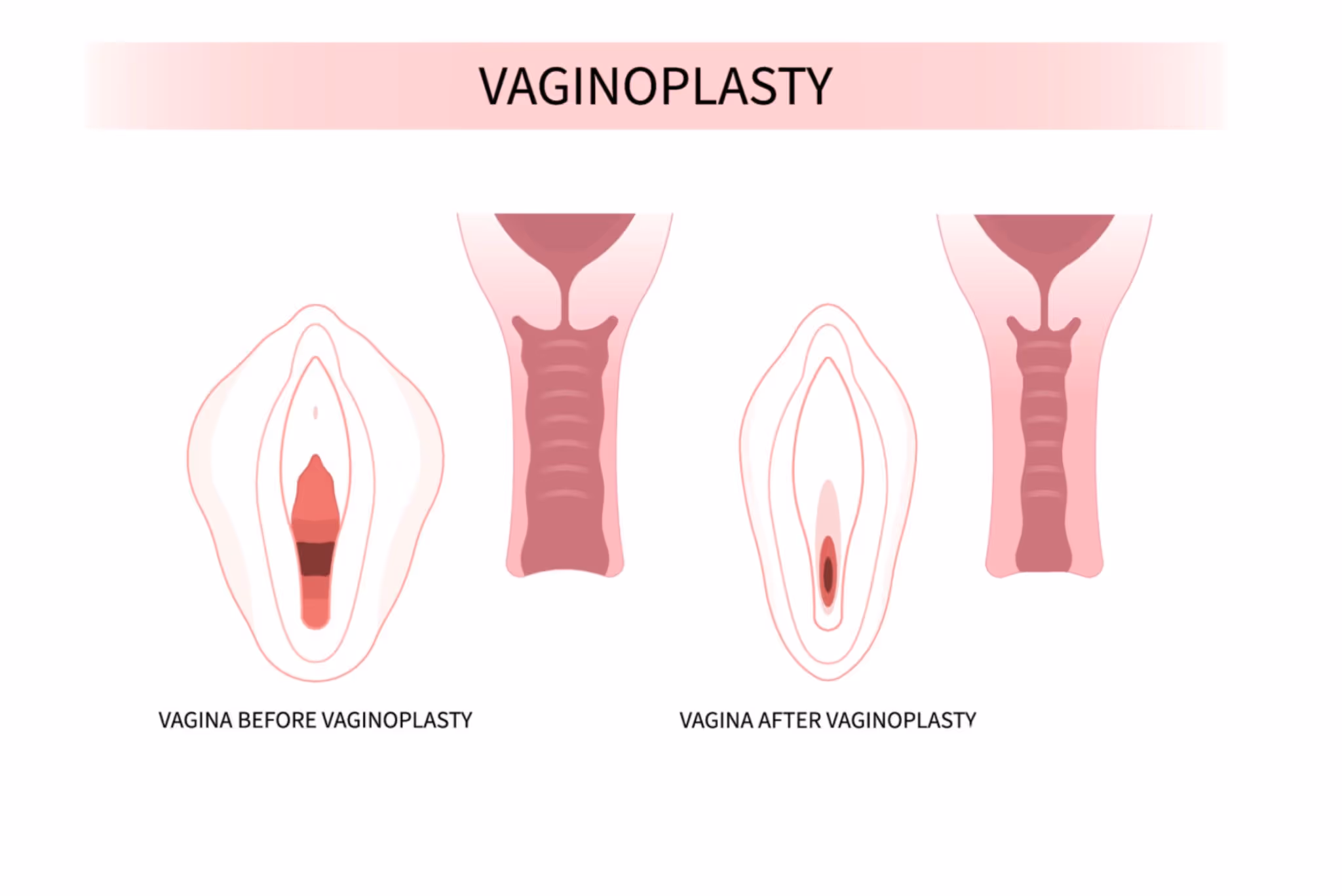 vaginoplasty at revive