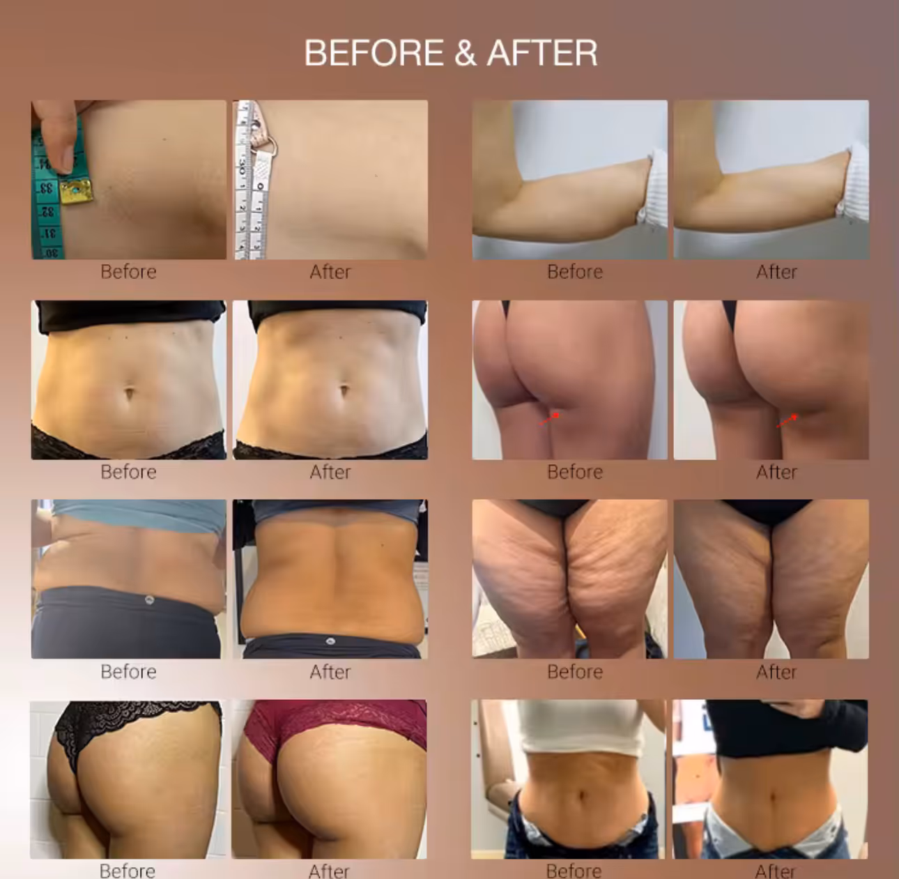 Renasculpt before & after images in Marlton, NJ