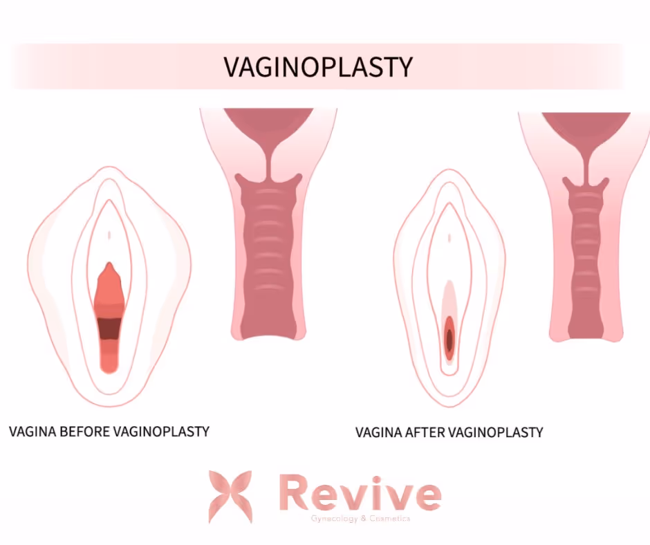 Vaginoplasty at Revive, serving NJ and Philadelphia