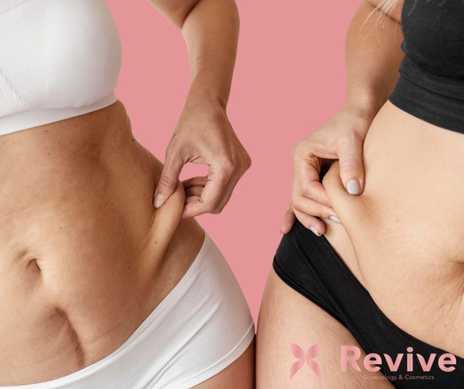 Liquid lipo for fat pockets