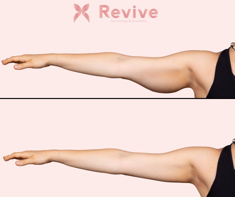 Liquid lipo to arm
