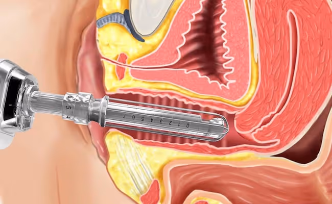 Vaginal laser at Revive, Marlton, NJ