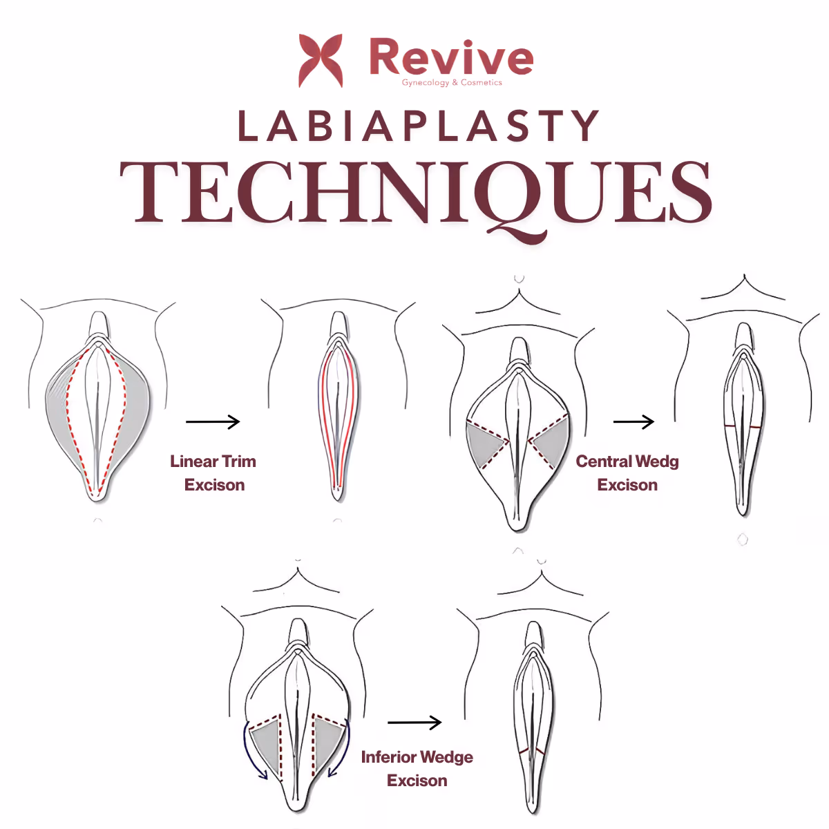 Labiaplasty techniques at Revive