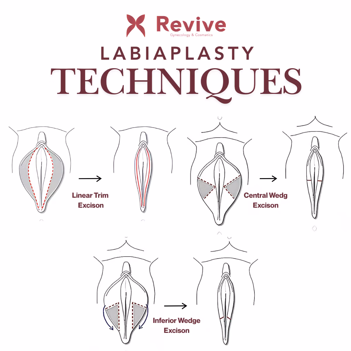 Labiaplasty techniques at Revivegyn