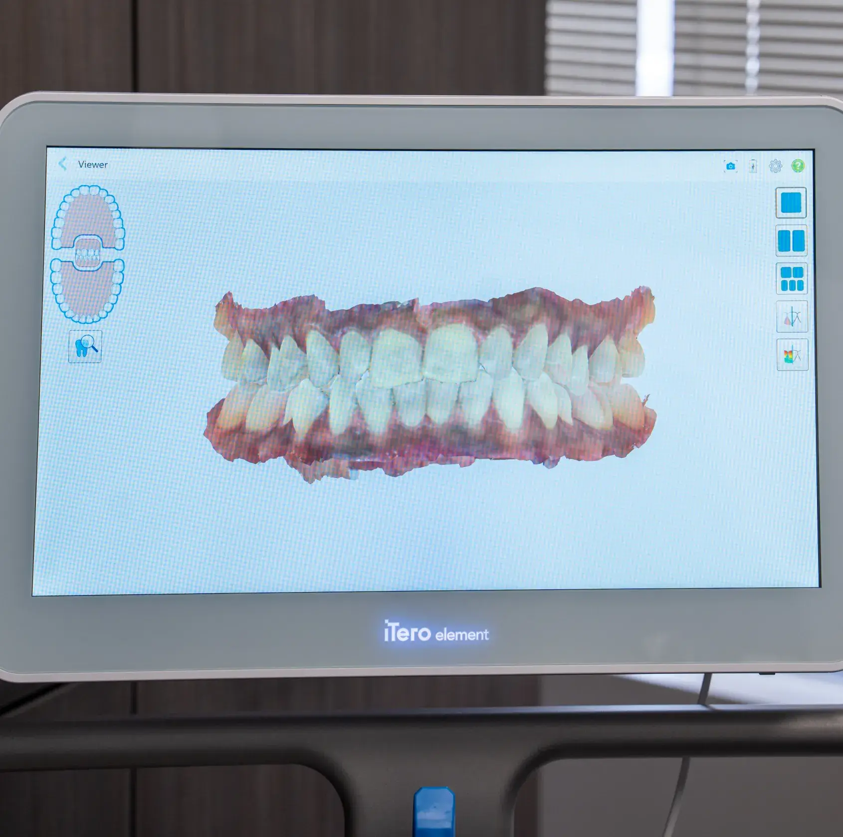 A dental scanner screen displaying a digital 3D model of teeth.