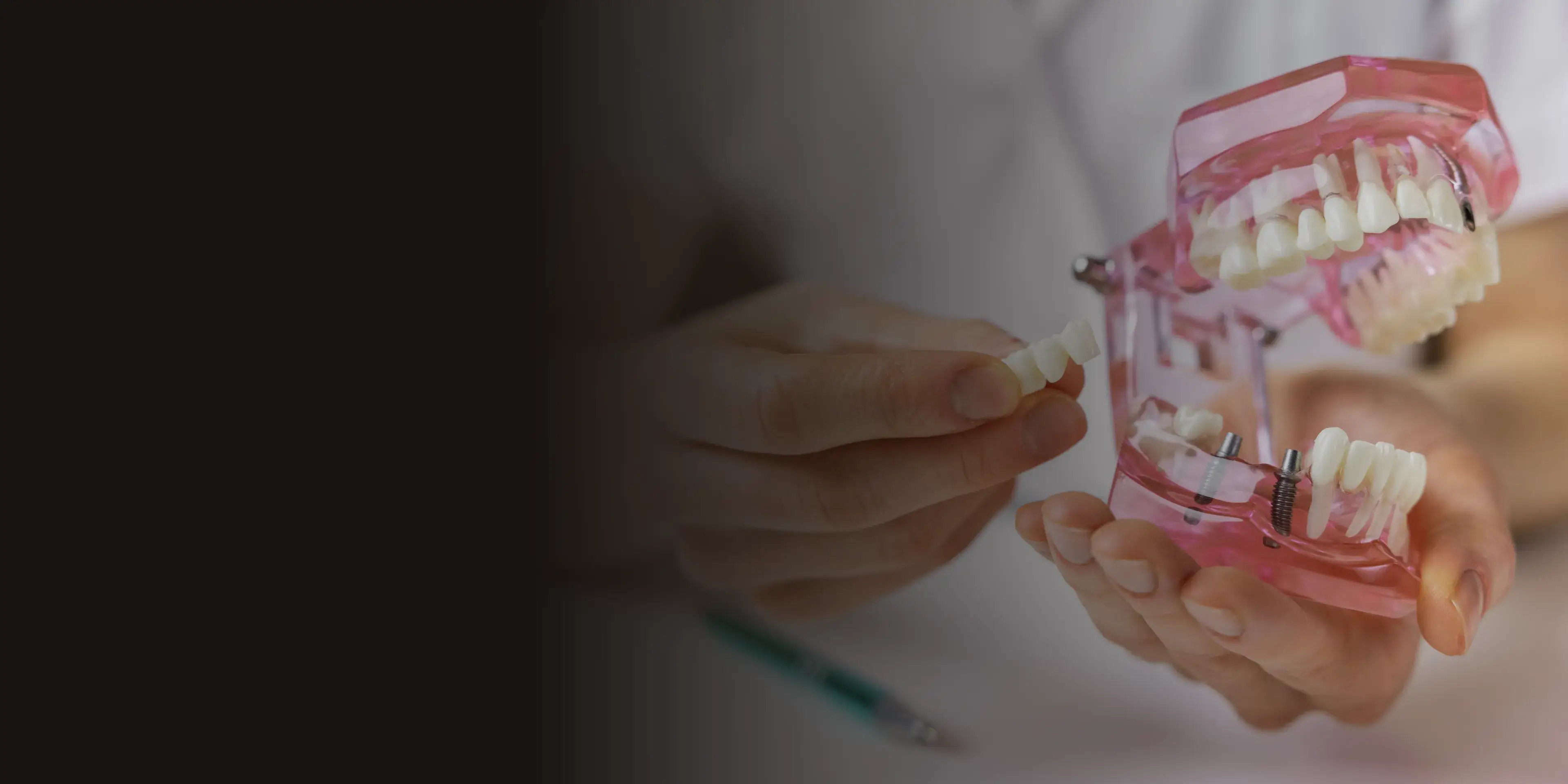 A person holds a dental model, inserting a tooth into it.