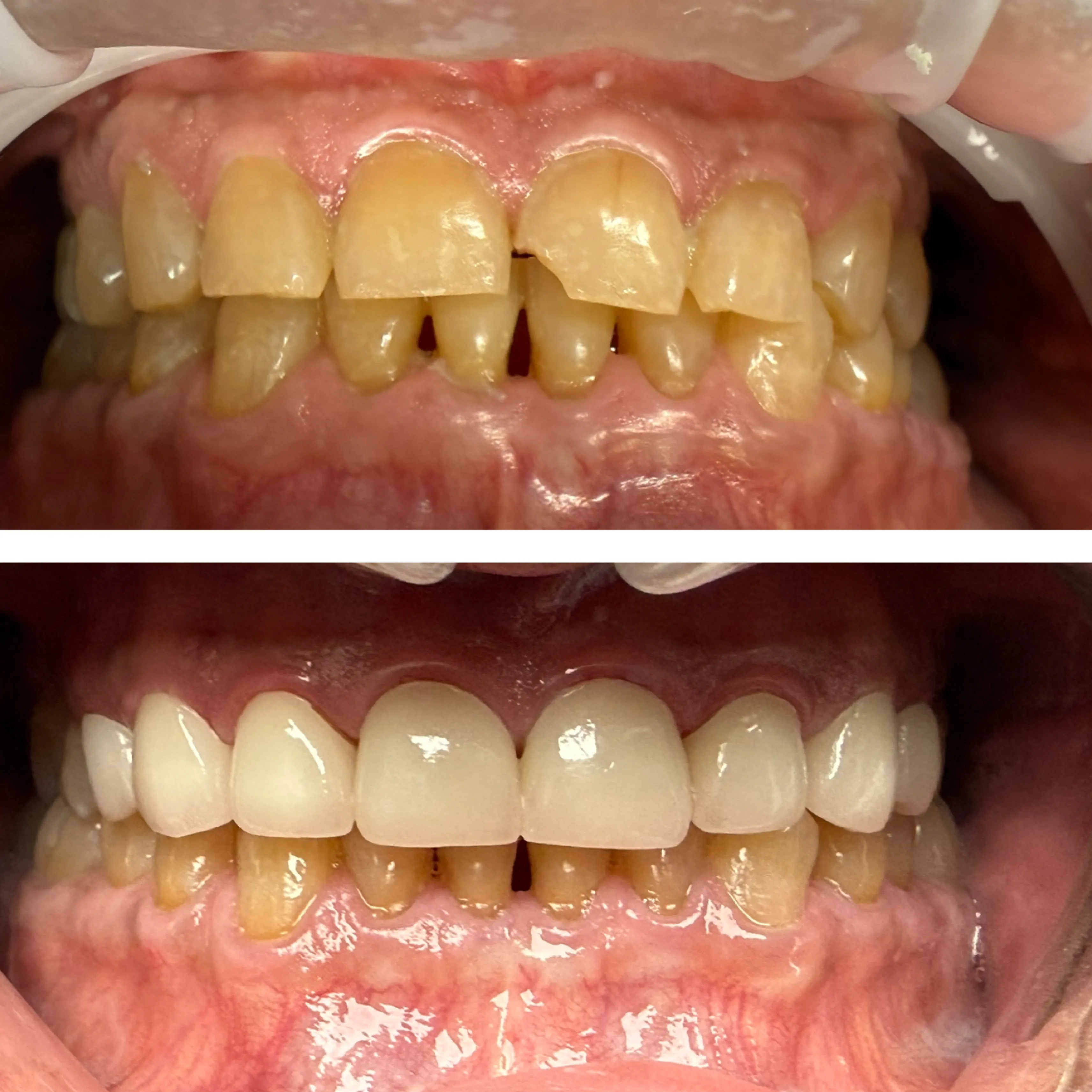 Before and after image of dental treatment showing significant improvement in teeth alignment and color.