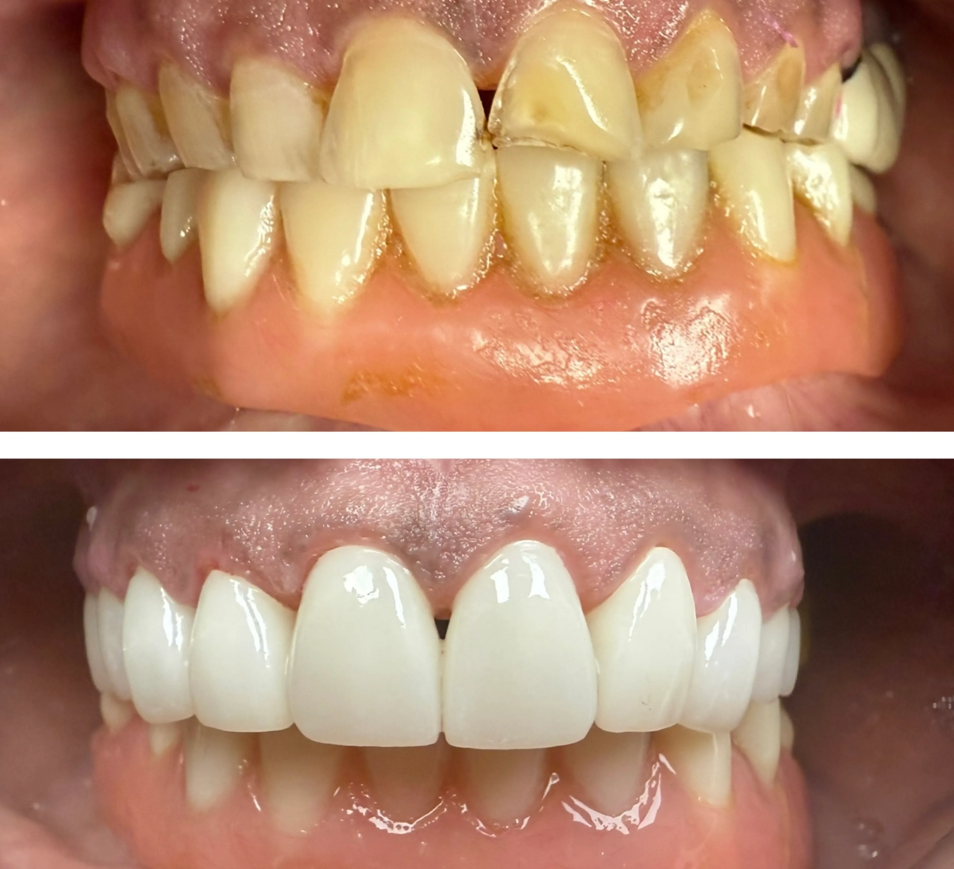 Close-up of teeth: top row shows worn and discolored teeth; bottom row shows bright, restored teeth.