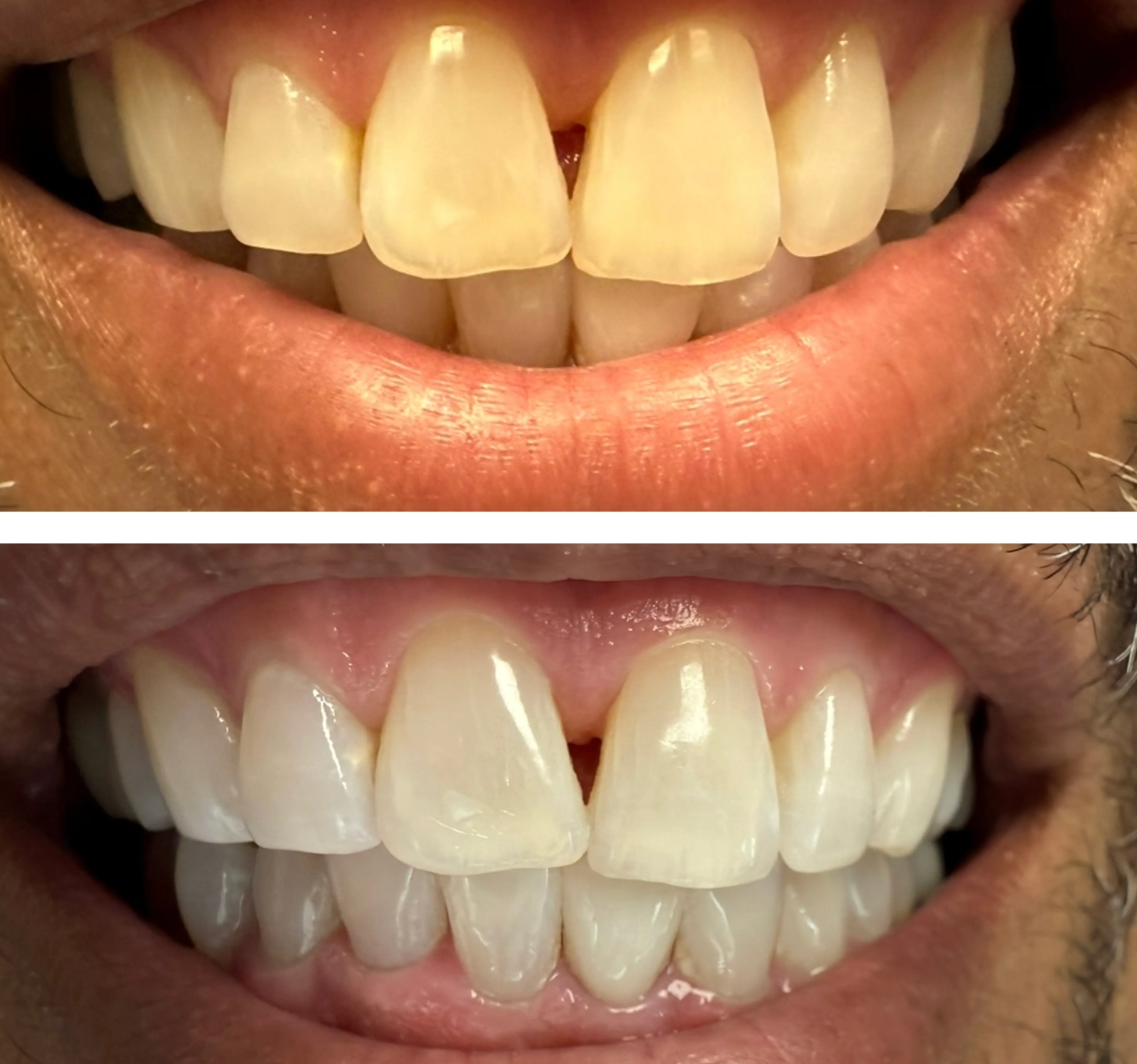 Two photos showing teeth before and after whitening, with noticeable color improvement.