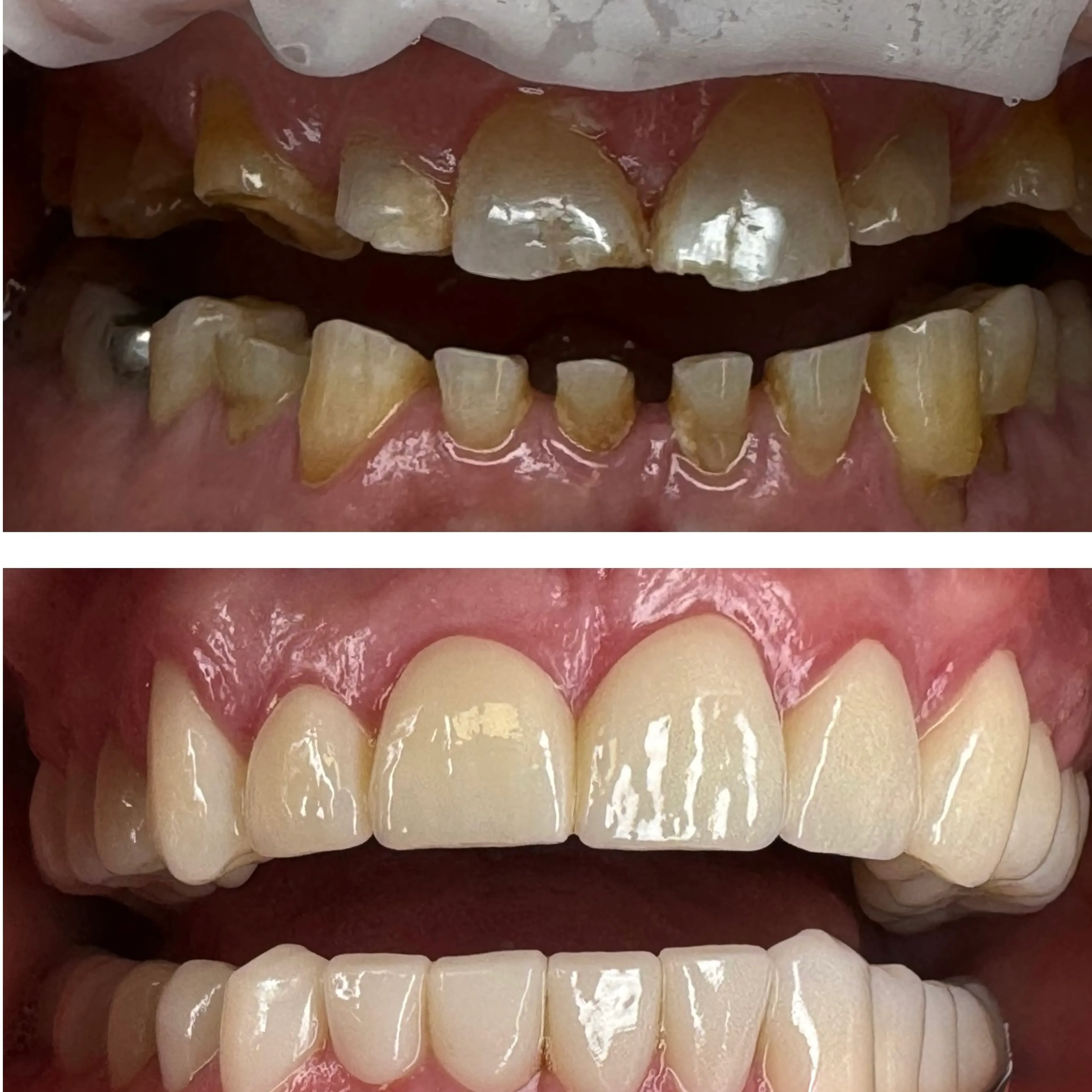 Top image shows damaged teeth; bottom image shows the teeth restored and healthy.