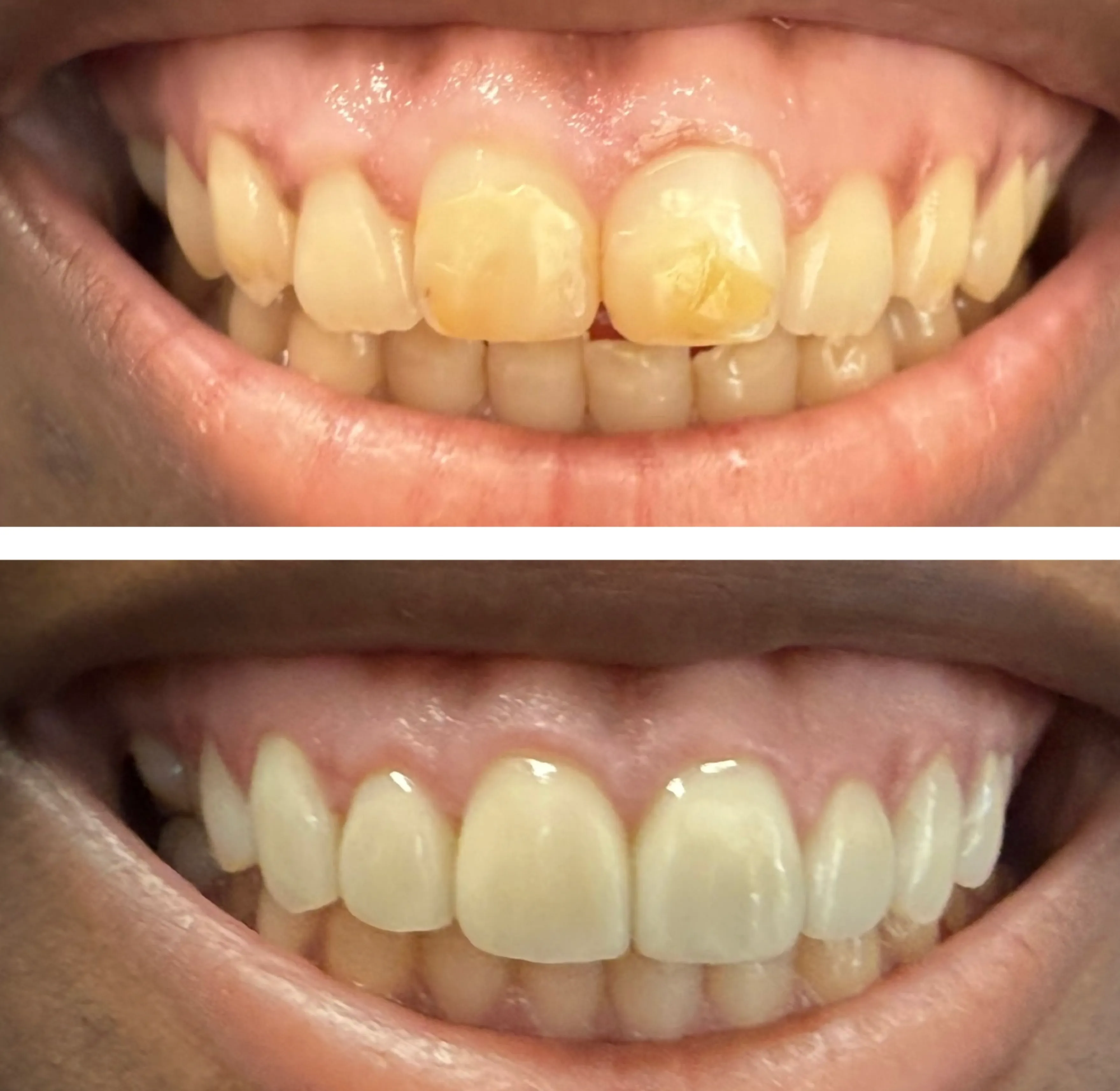 The image shows a dental transformation, with discolored, uneven teeth before and straight, white teeth after.