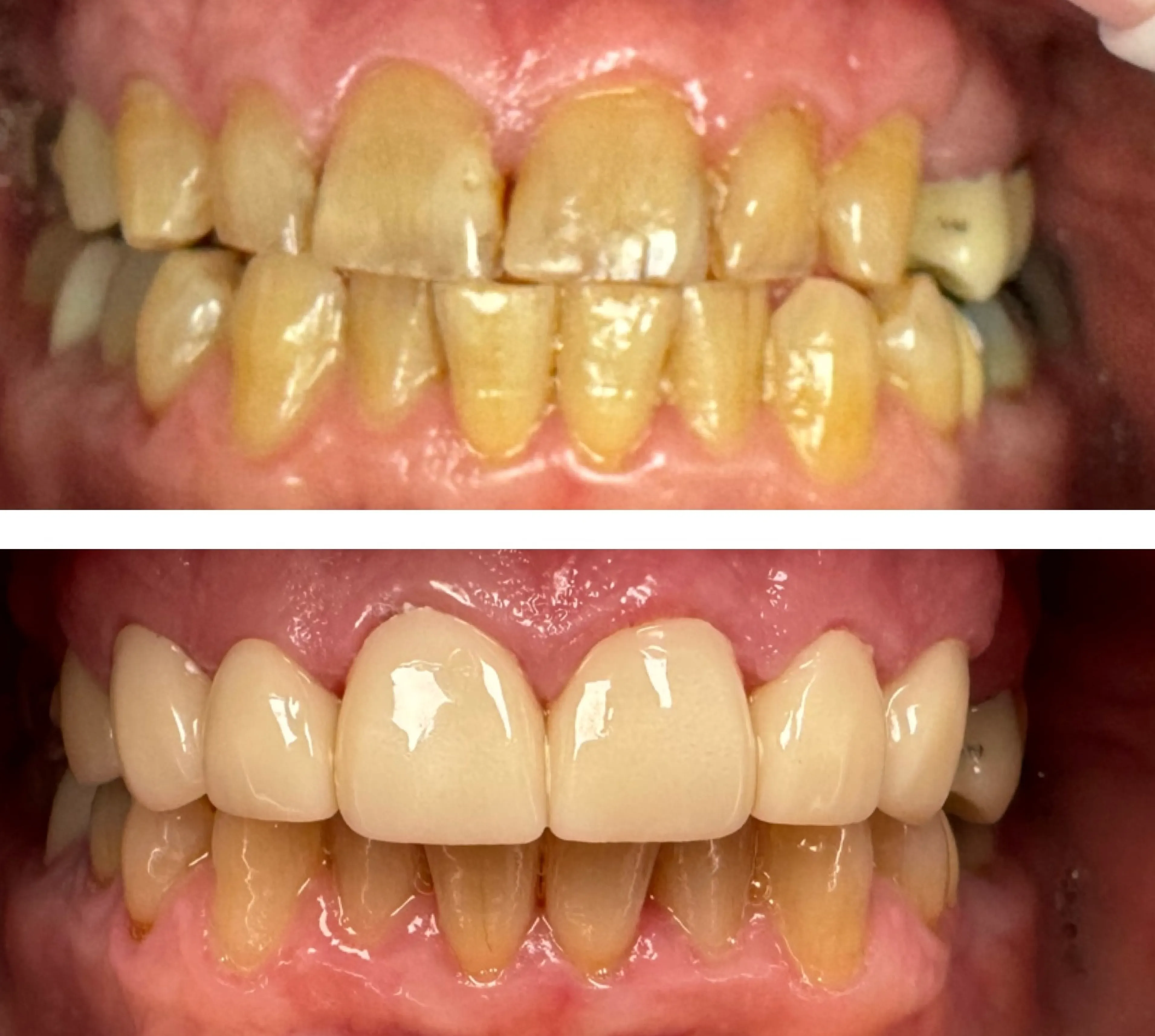 Top image shows discolored teeth; bottom image shows the same teeth whitened and aligned.