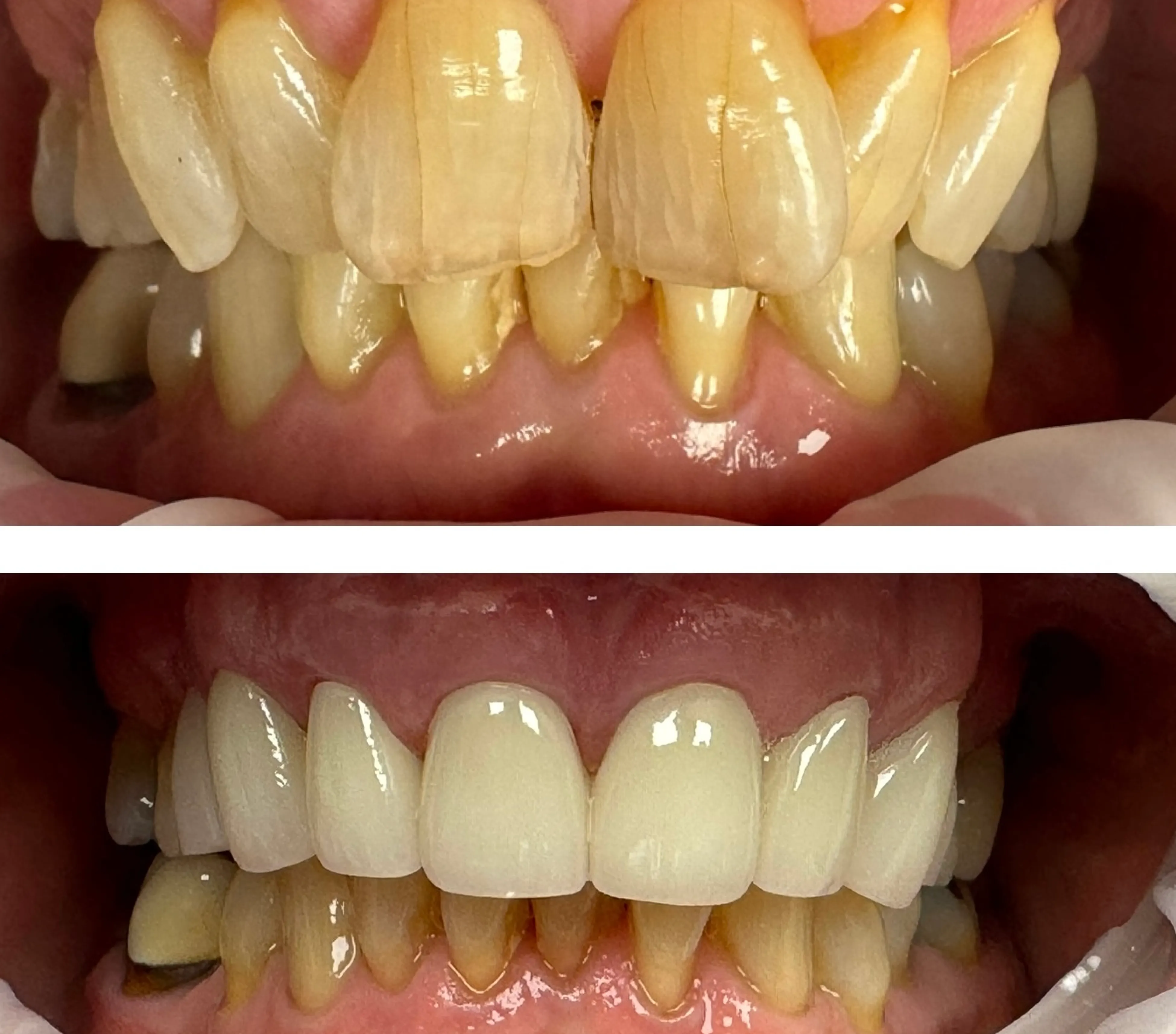 Two images of teeth before and after dental cleaning, showing noticeable whitening and improvement.
