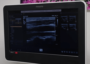 Screening Echocardiogram 