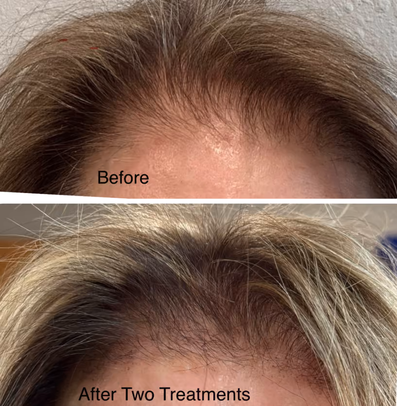 Tixel treatment for skin tightening in Redmond Oregon
