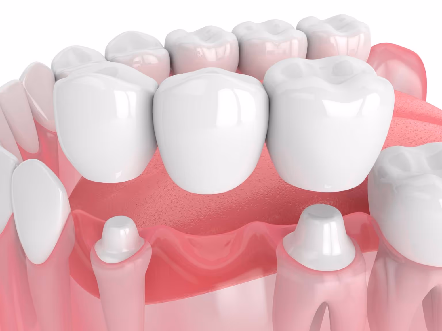 Dental Bridges near Coffs Harbour