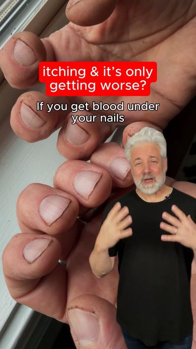 Video ad: a close-up of fingernails with the hook about itching that is only getting worse
