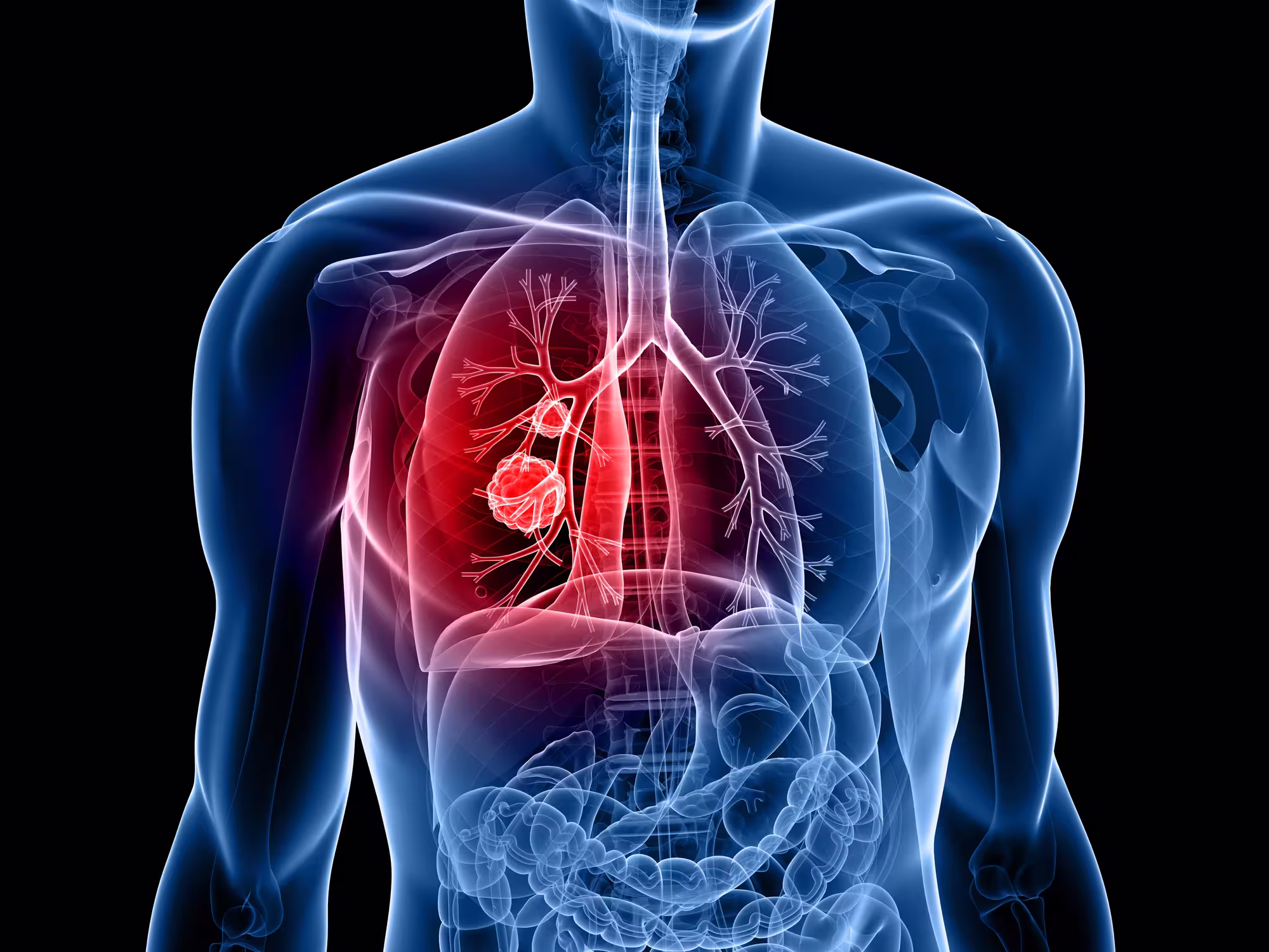 Speyside supported a global pharmaceutical company in assessing Argentina, Colombia, and Mexico’s readiness for a lung cancer screening program. The project involved analyzing the regulatory landscape, identifying policy gaps, and collaborating with advocacy groups and the scientific community to develop actionable recommendations. Deliverables included a saved lives calculator, communications toolkit, policy report, and a recommendations blueprint to guide future policymaker engagement.